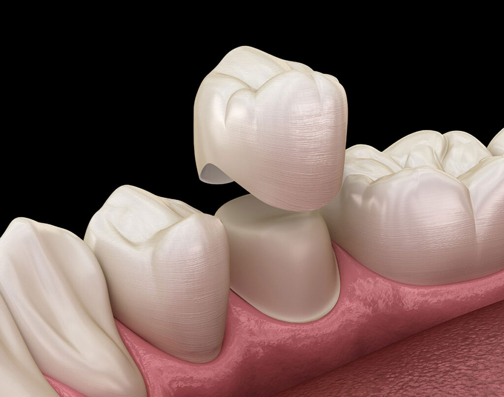 CEREC Same-Day Crowns in Largo, FL: A Convenient Way to Restore a Damaged Tooth