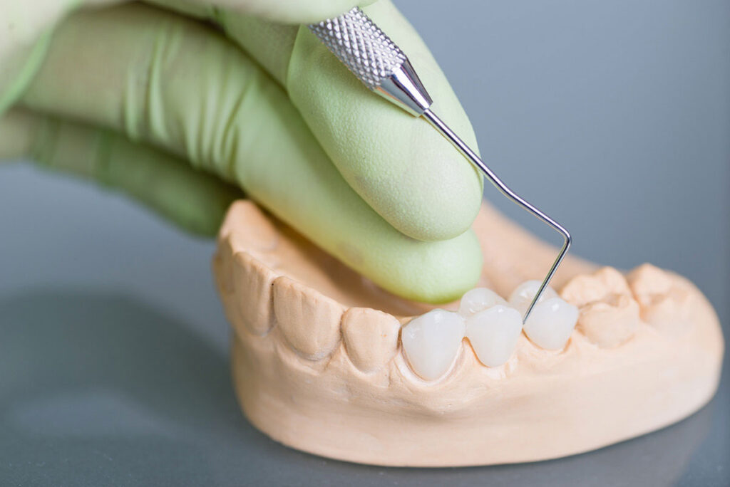 Dental Bridges in Largo, FL: Restore Missing Teeth With a Stable, Natural-Looking Smile